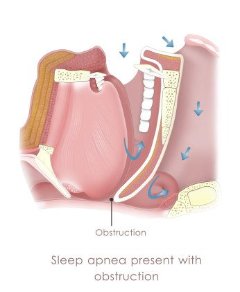 Sleep Apnea graphic showing obstruction
