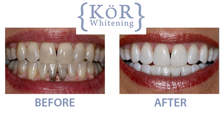 KOR Whitening before and after image
