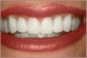 Whitening_A